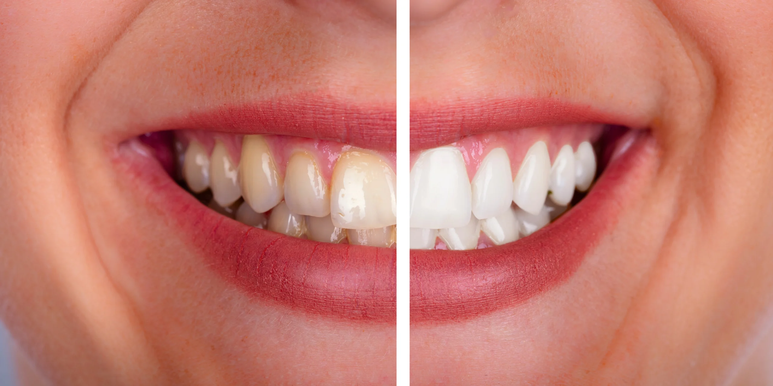 Urgencias Odontológicas en Bogotá | 24 horas Dr. José Rojas 1 Diseno de sonrisa antes y despues 1 scaled